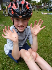edluke-injured Edward Luke showing his biking injuries